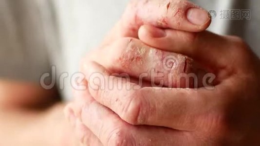 银屑病和湿疹的男性手指。 皮肤剥落的特写视频
