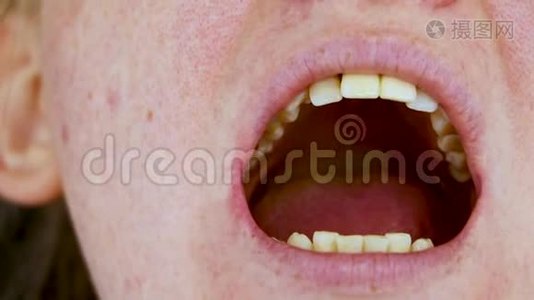 牙洞及牙管治疗.. 牙周炎的治疗视频