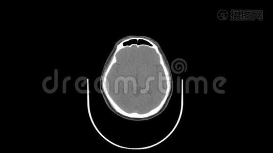 上颈顶视平滑运动CT扫描视频