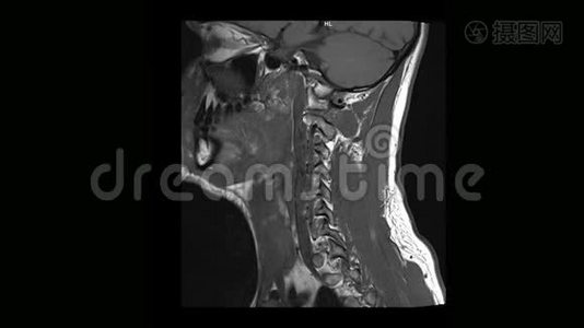 骨软骨病患者颈椎MRI计算机断层扫描视频