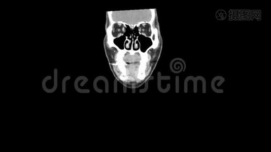 CT扫描整个颈部平滑运动视频