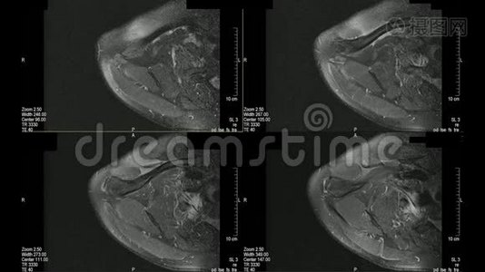 真正的MRI扫描医生检查男性肩部，发现病变，水肿和非常罕见的副乳腺囊肿视频