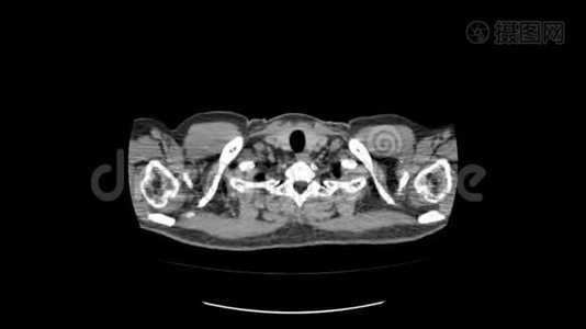 上腹部顶部CT扫描视频