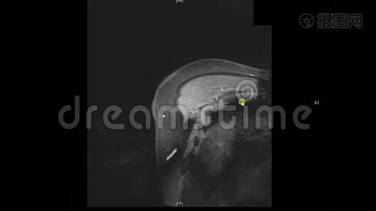 真正的MRI扫描医生检查男性肩部，发现病变，水肿和非常罕见的副乳腺囊肿视频