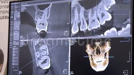 3D牙科数字建模修复.. 三维牙齿模型，病人扫描牙齿。 医生正在研究视频