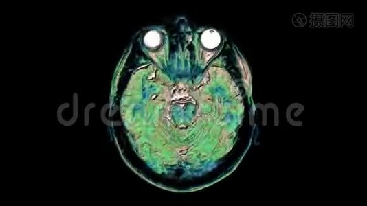 大量的彩色MRI扫描大脑和头部，以检测肿瘤。 诊断医疗工具视频