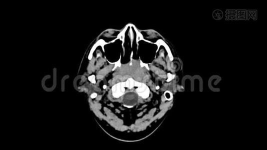 头顶视上脑CT扫描视频