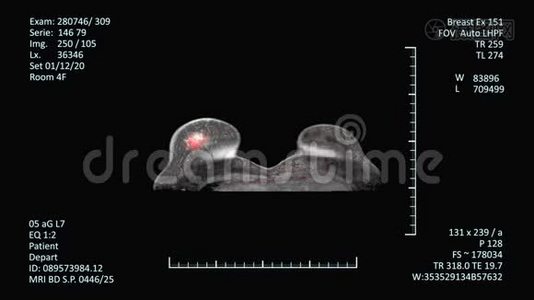磁共振扫描监视器，乳腺癌诊断视频
