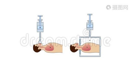 人体呼吸系统气道解剖。 正、负压人工肺通气原理视频