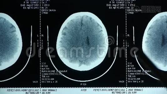 医生研究头部PET/ct扫描分析疾病，颅骨脑X线。视频