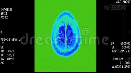 真实生命人脑核磁共振扫描与肿瘤医学研究新质量健康科学4k镜头股票动画视频