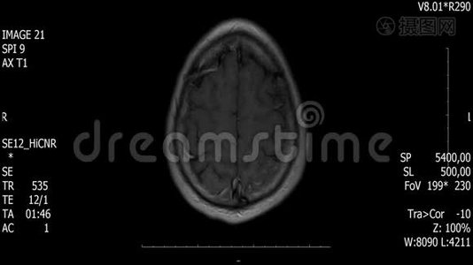 真实生命人脑核磁共振扫描与肿瘤医学研究新质量健康科学4k镜头股票动画视频