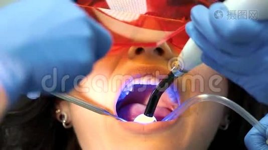 牙医使用的是固化光。视频