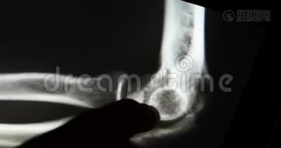 医生研究手臂、腿部和手掌关节X线胶片，用于触摸屏设备的分析。医疗医院。视频