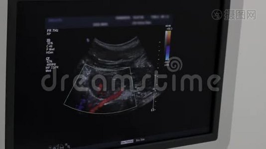 医生在肾动脉超声检查中显示颜色，特写视频