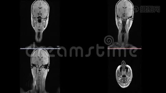 脑硬化微中风白斑的磁共振成像颈部视频