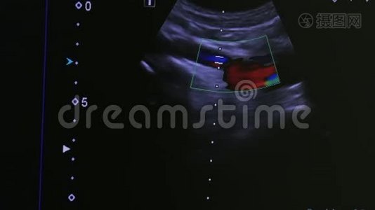 监测超声检查设备上的女性子宫图像。视频