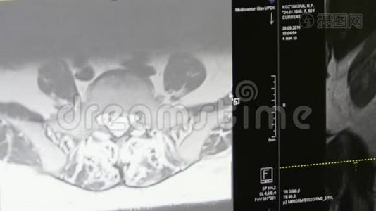 脊髓和脊柱断层扫描MRI扫描。视频