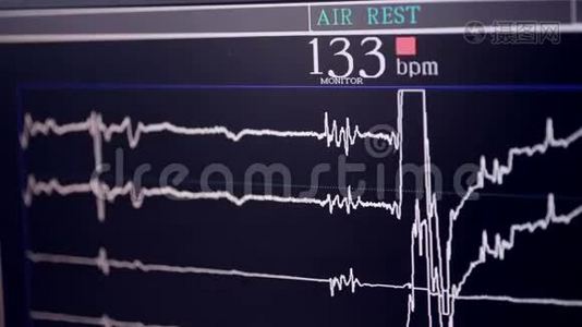 心脏造影。 在一家心脏病医院做心脏检查。视频