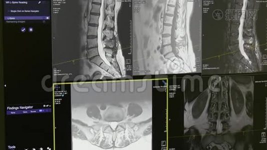 脊髓和脊柱断层扫描MRI扫描。视频