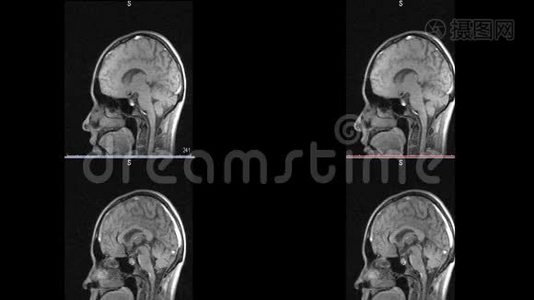脑硬化微中风白斑的磁共振成像视频