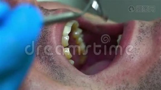 牙医的牙齿检查视频