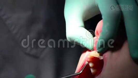 牙医检查牙龈炎的牙龈视频