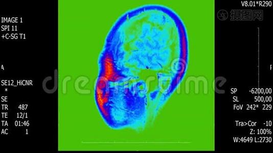 真实生命人脑核磁共振扫描与肿瘤医学研究新质量健康科学4k镜头股票动画视频