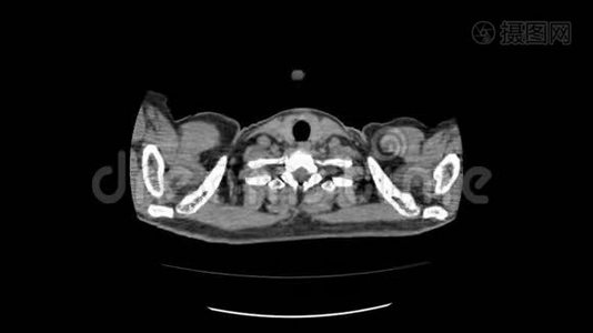 上腹部顶部CT扫描视频