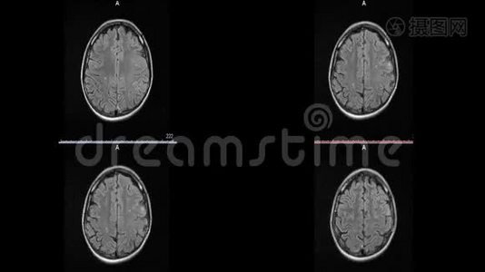 脑硬化微中风白斑的磁共振成像视频