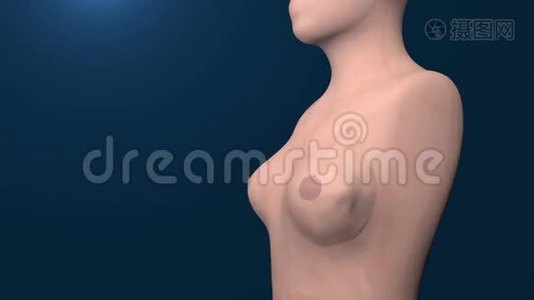 乳腺癌细胞生长动画。视频