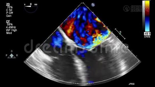 经食管超声检查心脏.视频