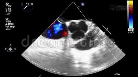经食管超声检查心脏.视频