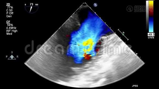 经食管超声检查心脏.视频