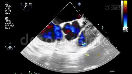 经食管超声检查心脏.视频