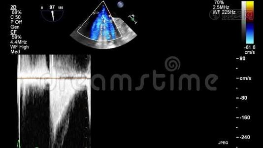 优质视频超声经食管检查心脏..视频