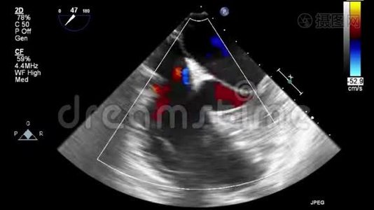 优质视频超声经食管检查心脏..视频
