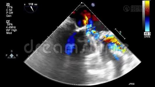 优质视频超声经食管检查心脏..视频