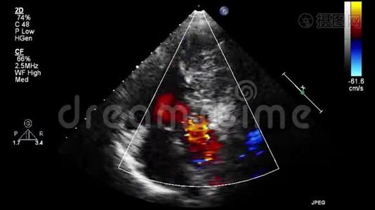 优质视频超声经食管检查心脏..视频