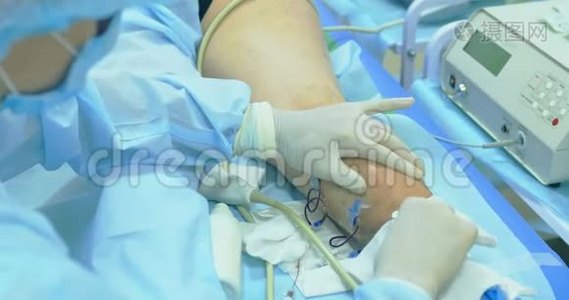 静脉曲张手术的创新方法，硬化治疗程序。 病人腿部特写镜头视频