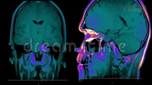 真实生命人脑核磁共振扫描与肿瘤医学研究新质量健康科学4k镜头股票动画视频