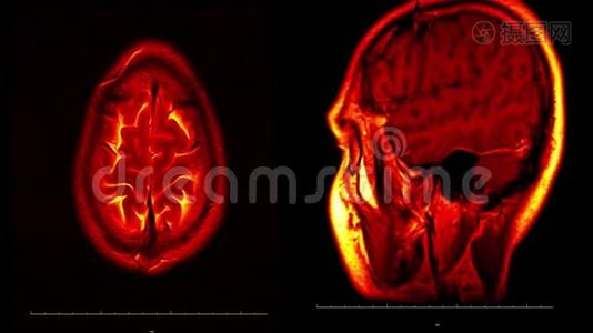 真实生命人脑核磁共振扫描与肿瘤医学研究新质量健康科学4k镜头股票动画视频