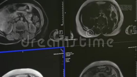 核磁共振扫描专业医疗设备上的脑部断层扫描。视频