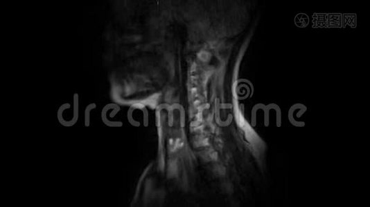 颈椎MRI的净化，突起和疝的检测视频