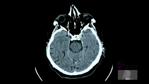 脑扫描脑静脉充血20秒视频
