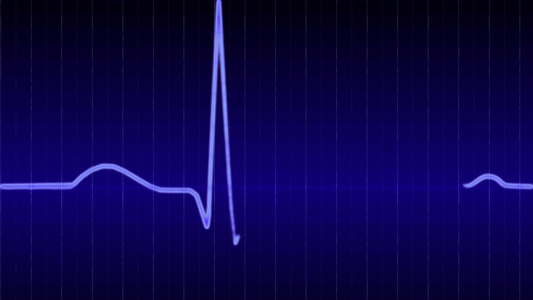 人心跳的心电图[肌钙蛋白]视频