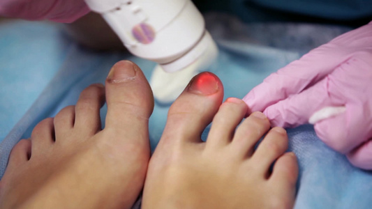 足科医生在医院用激光治疗甲真菌病一种脚趾甲的真菌感染视频