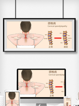 颈椎病科普医疗插画图片