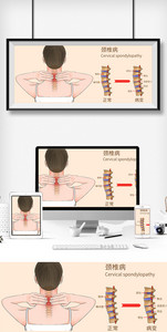 颈椎病科普医疗插画图片