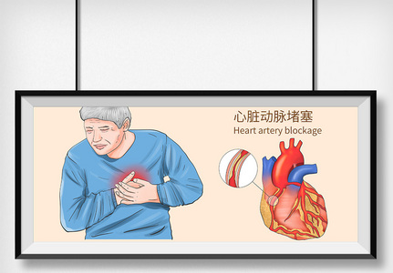 心脏动脉堵塞科普医疗插画高清图片